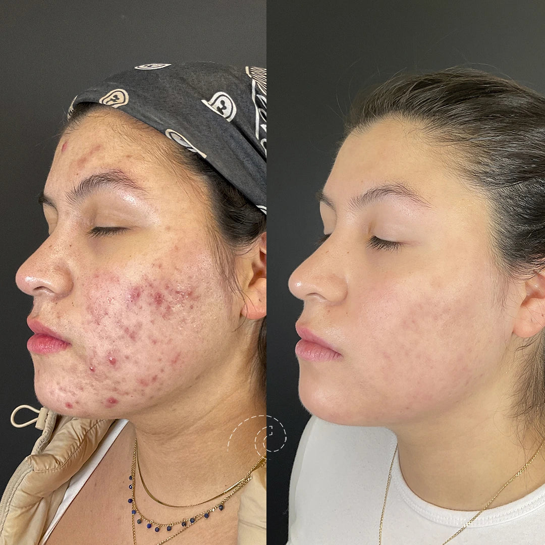 DR LEO - Rostro y cuerpo, sin más granos que esconder